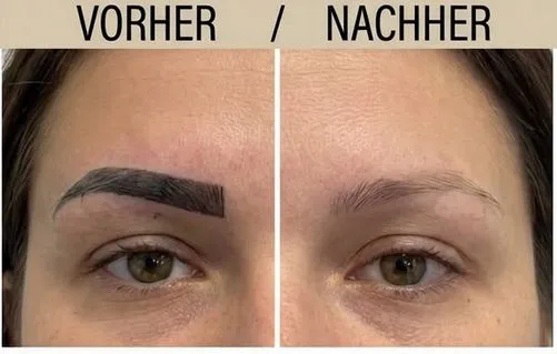 Vorher-Nachher: dunkles, kantiges Augenbrauen-PMU vollständig entfernt