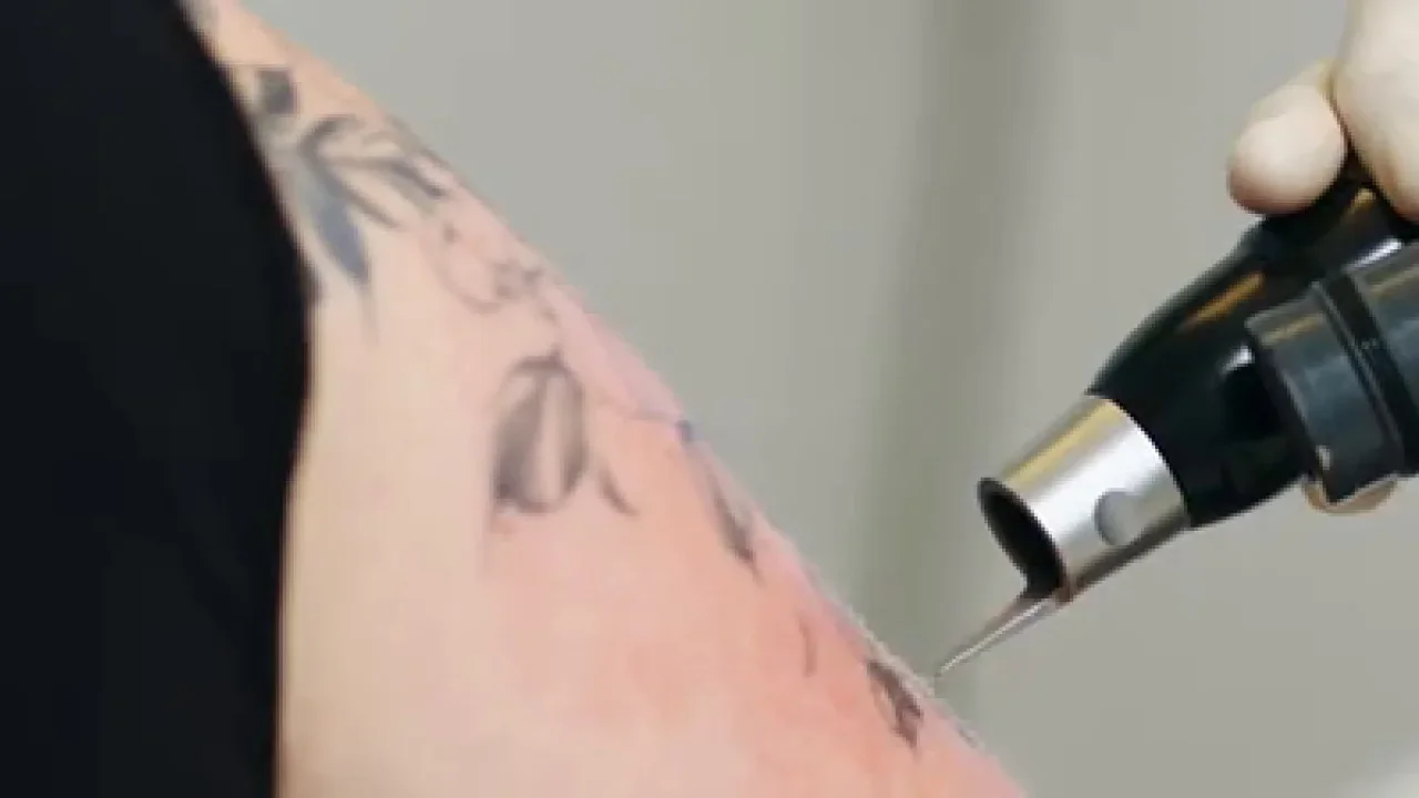 Behandlung mit dem PicoSure-Handstück in der Praxis Kreuzlingen
