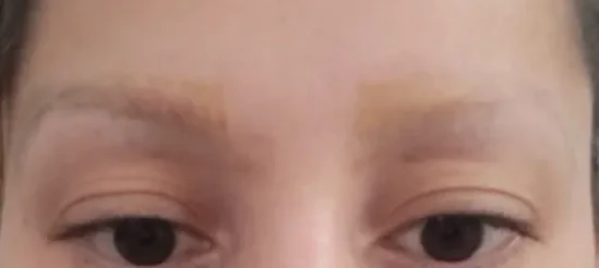 Nachher: dieselben Augenbrauen nach 4 Sitzungen PicoSure, Pigment entfernt