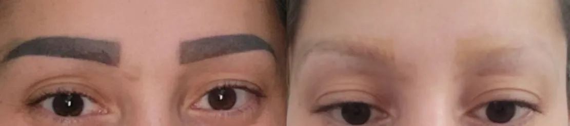 Microblading-Entfernung: Augenbrauen vor und nach 4 Sitzungen mit dem PicoSure-Laser